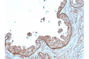 Formalin-fixed, paraffin-embedded human Prostate Carcinoma stained with Calpastatin Mouse Monoclonal Antibody (CAST/1550).