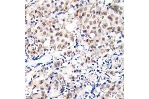 Immunohistochemistry of paraffin-embedded human breast carcinoma tissue, using Phospho-CDKN1B-T187 antibody (ABIN2987947). (CDKN1B anticorps  (pThr187))