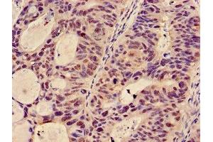 Immunohistochemistry of paraffin-embedded human colon cancer using ABIN7145363 at dilution of 1:100
