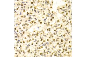 Immunohistochemistry of paraffin-embedded human kidney cancer using HDGF Antibody (ABIN1876535) at dilution of 1:100 (40x lens). (HDGF anticorps)