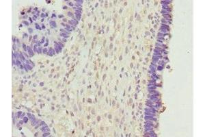Immunohistochemistry of paraffin-embedded human ovarian cancer using ABIN7145624 at dilution of 1:100