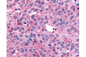 Anti-WNK1 / p65 antibody IHC of human Skin, Melanoma.