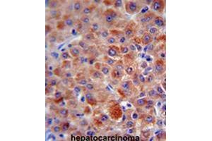 CFH antibody (Center) immunohistochemistry analysis in formalin fixed and paraffin embedded human hepatocarcinoma followed by peroxidase conjugation of the secondary antibody and DAB staining. (Complement Factor H anticorps  (Middle Region))