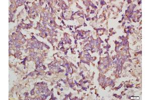 Formalin-fixed and paraffin embedded human lung carcinoma labeled with Rabbit Anti-Myosin VIIa Polyclonal Antibody, Unconjugated  at 1:200 followed by conjugation to the secondary antibody and DAB staining (Myosin VIIA anticorps  (AA 851-950))
