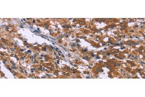 Immunohistochemistry of paraffin-embedded Human thyroid cancer tissue using SKI Polyclonal Antibody at dilution 1:40