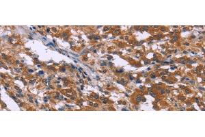 Immunohistochemistry of paraffin-embedded Human thyroid cancer tissue using SKI Polyclonal Antibody at dilution 1:40 (SKI anticorps)