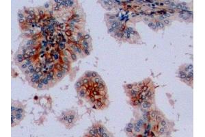 Detection of VIM in Human Prostate Tissue using Polyclonal Antibody to Vimentin (VIM)