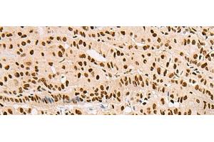 Immunohistochemistry of paraffin-embedded Human thyroid cancer tissue using XRCC4 Polyclonal Antibody at dilution of 1:60(x200) (XRCC4 anticorps)