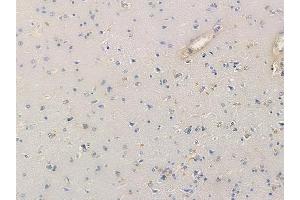 ABIN6259014 and ABIN6276247 at 1/100 staining human glioblastoma by IHC-P.