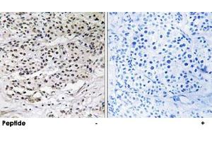 Immunohistochemistry analysis of paraffin-embedded human breast carcinoma tissue using AZI1 polyclonal antibody . (AZI1 anticorps)