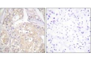 Immunohistochemistry analysis of paraffin-embedded human breast carcinoma, using FGFR1 (Phospho-Tyr766) Antibody. (FGFR1 anticorps  (pTyr766))