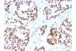 Formalin-fixed, paraffin-embedded human Prostate Carcinoma stained with NKX3.