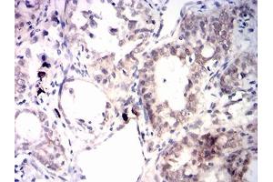 Immunohistochemical analysis of paraffin-embedded cervical cancer tissues using IGF2BP3 mouse mAb with DAB staining.