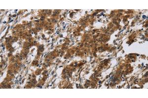 Immunohistochemistry of paraffin-embedded Human gastic cancer using IL17RB Polyclonal Antibody at dilution of 1:40 (IL17 Receptor B anticorps)