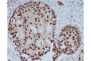 Immunohistochemical analysis of paraffin-embedded human breast carcinoma with HP1 alpha mouse mAb (3G2-H10-A6, 1:400 diluted ),showing nuclear localization. (CBX5 anticorps)