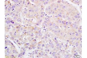 Formalin-fixed and paraffin embedded human liver carcinoma labeled with Anti-Phospho-Wee1(Ser642) Polyclonal Antibody, Unconjugated  at 1:200 followed by conjugation to the secondary antibody and DAB