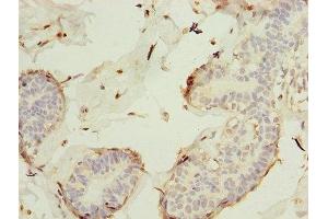 Immunohistochemistry of paraffin-embedded human breast cancer using ABIN7157312 at dilution of 1:100