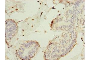 Immunohistochemistry of paraffin-embedded human breast cancer using ABIN7157312 at dilution of 1:100 (KEL anticorps  (AA 201-500))