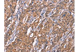 The image on the left is immunohistochemistry of paraffin-embedded Human gastic cancer tissue using ABIN7190999(HRASLS2 Antibody) at dilution 1/20, on the right is treated with synthetic peptide. (HRASLS2 anticorps)