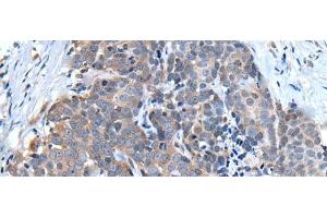 Immunohistochemistry of paraffin-embedded Human thyroid cancer tissue using UBQLN2 Polyclonal Antibody at dilution of 1:45(x200)