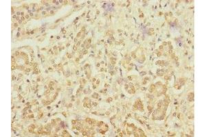 Immunohistochemistry of paraffin-embedded human pancreatic cancer using ABIN7167095 at dilution of 1:100