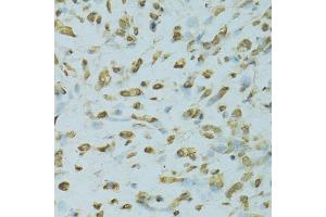 Immunohistochemistry of paraffin-embedded human gastric cancer using SAFB antibody.