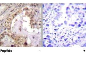 Immunohistochemical analysis of paraffin-embedded human lung carcinoma tissue using BCL2L1 polyclonal antibody .