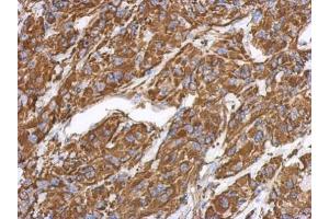 IHC-P Image Immunohistochemical analysis of paraffin-embedded U373 xenograft, using Vimentin, antibody at 1:500 dilution. (Vimentin anticorps)