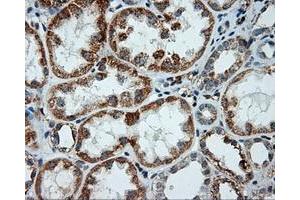 Immunohistochemical staining of paraffin-embedded Adenocarcinoma of ovary tissue using anti-LIPG mouse monoclonal antibody. (LIPG anticorps)
