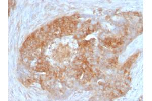 Formalin-fixed, paraffin-embedded human Ovarian Carcinoma stained with Fascin-1 Mouse Monoclonal Antibody (FSCN1/417)
