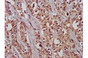 IHC image of ABIN7166315 diluted at 1:200 and staining in paraffin-embedded human liver cancer performed on a Leica BondTM system.