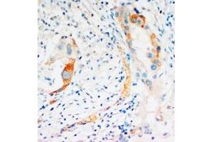 Immunohistochemical staining of CASP2 on formalin fixed, paraffin embedded human mammary cancer with CASP2 polyclonal antibody . (Caspase 2 anticorps  (C-Term))