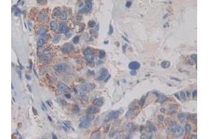 Detection of MAPKAPK2 in Human Breast cancer Tissue using Polyclonal Antibody to MAP Kinase Activated Protein Kinase 2 (MAPKAPK2) (MAPKAP Kinase 2 anticorps  (AA 139-367))