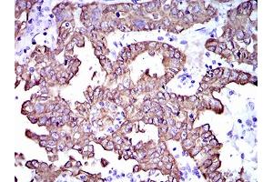 Immunohistochemical analysis of paraffin-embedded endometrial cancer tissues using CK5 mouse mAb with DAB staining. (Cytokeratin 5 anticorps  (AA 316-590))
