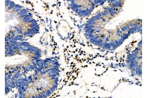 ABIN6257267 and ABIN6274157 at 1/100 staining Human colorectal cancer by IHC-P. (Homeobox C6 anticorps  (N-Term))