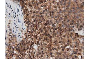 Immunohistochemical staining of paraffin-embedded Carcinoma of Human pancreas tissue using anti-PEPD mouse monoclonal antibody.