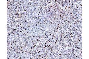 IHC analysis of TOP2A using anti-TOP2A antibody (ABIN7602988).