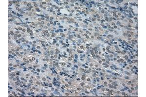 Immunohistochemical staining of paraffin-embedded Carcinoma of thyroid tissue using anti-BUB1Bmouse monoclonal antibody. (BUB1B anticorps)