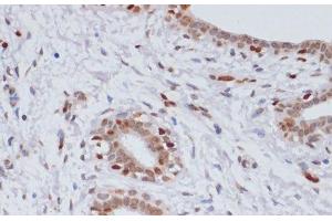 Immunohistochemistry of paraffin-embedded Human breast cancer using TriMethyl-Histone H3-K27 Polyclonal Antibody at dilution of 1:100 (40x lens). (Histone 3 anticorps  (3meLys27))