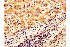 IHC image of ABIN7159817 diluted at 1:300 and staining in paraffin-embedded human liver cancer performed on a Leica BondTM system. (OGN anticorps  (AA 21-298))