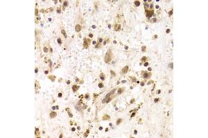 Immunohistochemistry of paraffin-embedded human liver cancer using PRPF3 Antibody (ABIN5973192) at dilution of 1/100 (40x lens). (PRPF3 anticorps)
