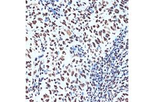 Immunohistochemistry of paraffin-embedded human esophageal cancer using SET/T Rabbit mAb (ABIN7270265) at dilution of 1:100 (40x lens).
