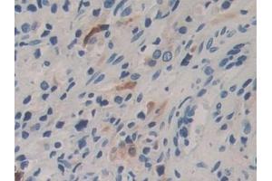 Detection of CPB1 in Human Prostate cancer Tissue using Polyclonal Antibody to Carboxypeptidase B1, Tissue (CPB1) (CPB1 anticorps  (AA 111-417))