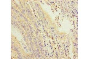 Immunohistochemistry of paraffin-embedded human colon cancer using ABIN7168417 at dilution of 1:100 (PDE6A anticorps  (AA 656-860))