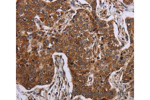 Immunohistochemistry of Human liver cancer using ACP6 Polyclonal Antibody at dilution of 1:30 (ACP6 anticorps)