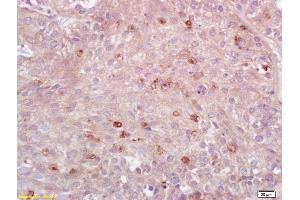 Formalin-fixed and paraffin embedded human lung carcinoma labeled with Anti-MHC Class II/HLA-DPB1 Polyclonal Antibody, Unconjugated (ABIN753928) at 1:200 followed by conjugation to the secondary antibody and DAB staining. (HLA-DPB1 anticorps  (AA 101-210))