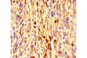 Immunohistochemistry of paraffin-embedded human melanoma using ABIN7152273 at dilution of 1:100 (Exophilin 5 anticorps  (AA 1235-1490))