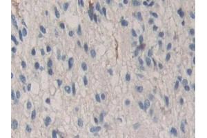 Detection of CDH16 in Human Glioma Tissue using Polyclonal Antibody to Cadherin 16 (CDH16)