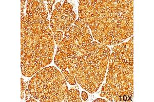 IHC staining of melanoma tissue (10X) with Tyrosinase antibody (T311).