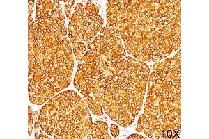 IHC staining of melanoma tissue (10X) with Tyrosinase antibody (T311). (TYR anticorps)